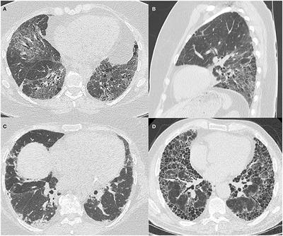 A multidisciplinary approach to the diagnosis of antisynthetase syndrome